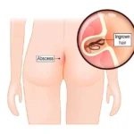 Pilonidal Dimple 2