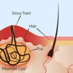 Pilonidal Dimple 3