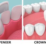 Porcelain Veneer Crown-Implant 1