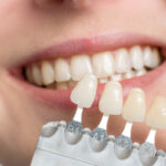 Porcelain Veneer Crown-Implant 2