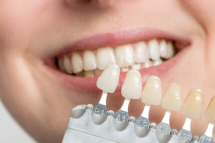 Porcelain Veneer Crown-Implant 2