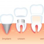 Porcelain Veneer Crown-Implant 3