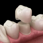 Porcelain Veneer Crown-Implant 4