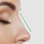 Rhinoplasty 1