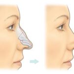 Rhinoplasty 5