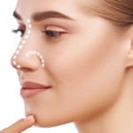 Rhinoplasty 6