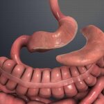 Sleeve Gastrectomy