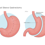 Sleeve Gastrectomy 2
