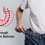 Sleeve Gastrectomy 3