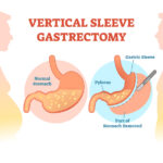 Sleeve Gastrectomy 4