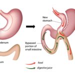 Sleeve Revision (Sleeve to Bypass)