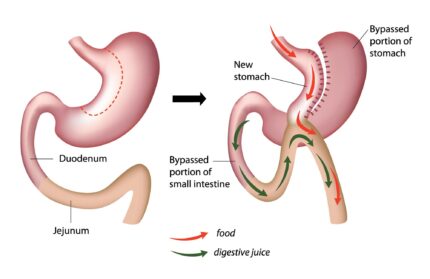 Sleeve Revision (Sleeve to Bypass)