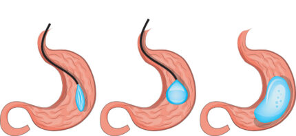 Stomach Balloon (12 months)