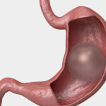 Stomach Balloon (12 months)2