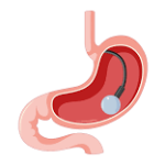 Swallowable Stomach Balloon
