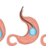 Swallowable Stomach Balloon2