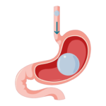 Swallowable Stomach Balloon3