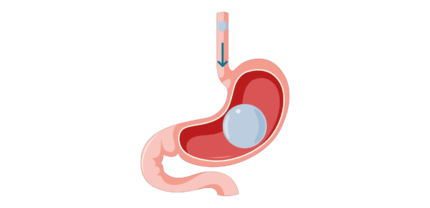 Swallowable Stomach Balloon3 Swallowable Stomach Balloon3