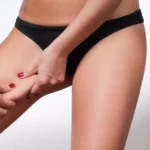 Thigh Lift 1