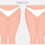 Thigh Lift 4