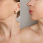 Woman,Double,Chin,After,Treatment