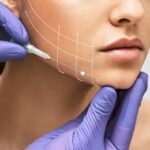 Thread Lift 5