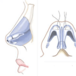 Tip-Plasty 1
