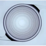 Trifocal IOL3