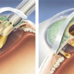 Trifocal Toric