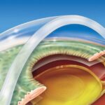 Trifocal Toric3