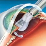 Trifocal Toric4