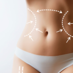 Tummy Tuck 1
