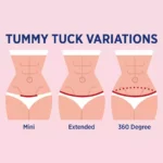 Tummy Tuck 3