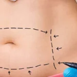 Tummy Tuck 4