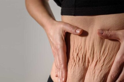 Tummy Tuck 5