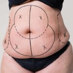 Tummy Tuck 6