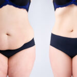 Tummy Tuck 7