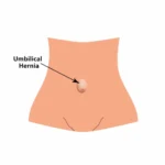 Umbilical Repair 1