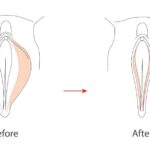 Vaginoplasty + Labiaplasty 1