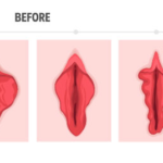 Vaginoplasty + Labiaplasty 3