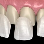 Zirconium Veneer Crown 1