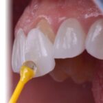 Zirconium Veneer Crown 2