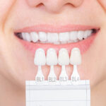 Zirconium Veneer Crown 3