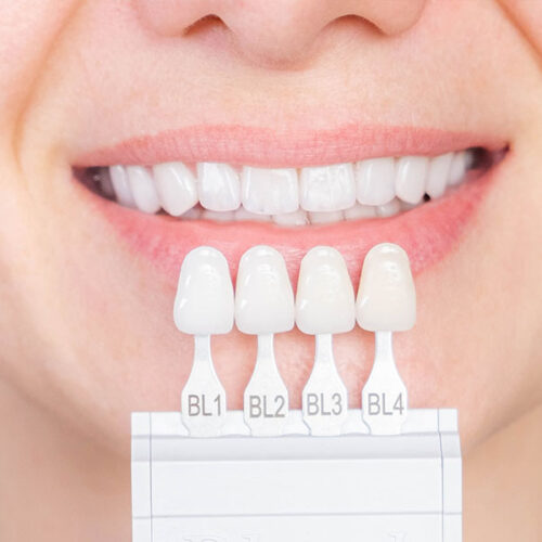 Zirconium Veneer Crown 3