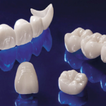 Zirconium Veneer Crown 4