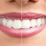 hollywood-smile