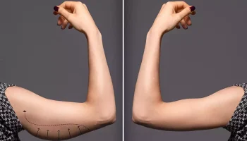 Arm Lift 2