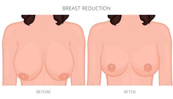 BREAST REDUCTION 5