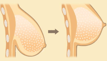 BREAST UPLIFT 1