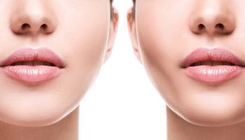 Female,Face,Comparison,After,Successful,Buccal,Fat,Extraction,Plastic,Surgery